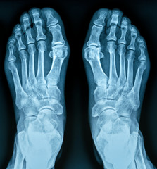 X-ray of both human foot