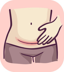Symptom Redness Cesarean Wound Illustration - 343130825