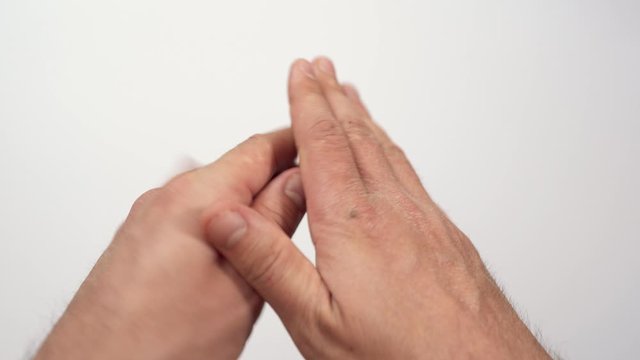Closeup of dry and cracked caucasian man's hands due to the use of alcohol-based disinfectant solutions, reduced sun exposure, lack of vitamin D. Dehydrated chapped skin, psoriasis, dermatitis disease