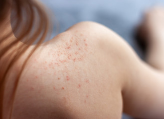 The shoulder of a child with red spots signs of dermatitis.