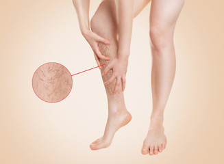 Varicosity. A woman grabs a sore leg with diseased blood vessels. Zoomed image of vessels in a...