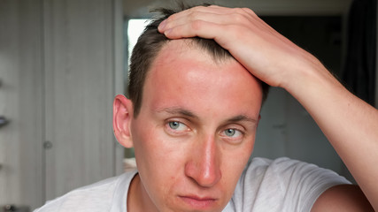 young guy touches red sunburned face sitting at home closeup
