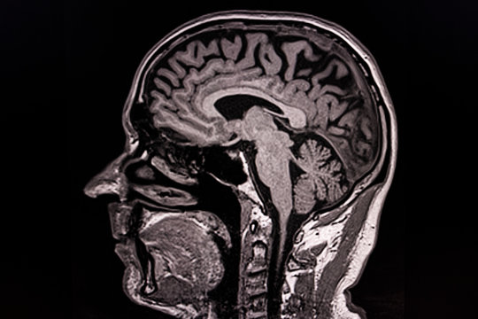 MRT images of a human head