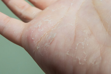 Hand was dry, flaky, itchy and peeling.