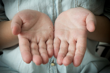 Dermatitis. Dry, flaky and peeling fingers on hand.