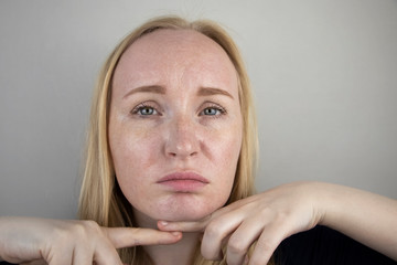 Oily and problem skin. Portrait of a blonde girl with acne, oily skin and pigmentation