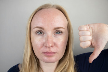 Oily and problem skin. Portrait of a blonde girl with acne, oily skin and pigmentation
