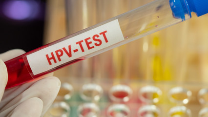 Doctor wearing blue gloves holding test tube,  In there, the blood that was examined for the HPV...