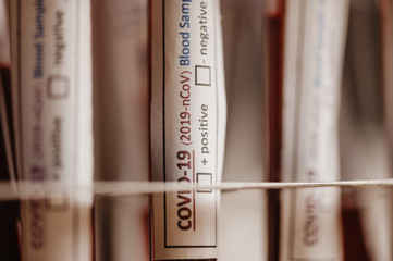 blood test result for the new rapidly spreading Coronavirus, originating in Wuhan, China