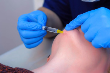 Doctor surgeon making anesthesia injection on woman's face before laser removal of scar on chin, face closeup. cosmetic treatment in beauty clinic. One day surgery concept. Remove surgical procedure.