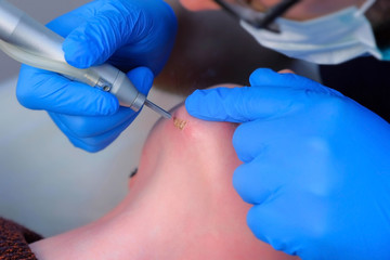 Surgeon removing scar on woman's chin using laser, burning skin, beauty treatment, closeup view. Cosmetic treatment in clinic. One day surgery concept. Removing mark after wound surgical procedure.