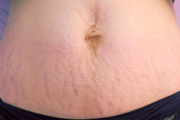 Woman's abdomen after childbirth and pregnancy, skin with heavy stretches, closeup view. Postpartum recovery concept. Before carboxytherapy treatment and remove of skin tags and stretches in clinic. - obrazy, fototapety, plakaty