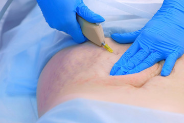 Doctor making injection of carbon dioxide on patient abdomen on carboxytherapy, tummy closeup....