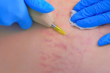 Doctor making injection of carbon dioxide on patient abdomen on carboxytherapy, tummy closeup....