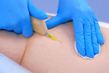 Doctor making injection of carbon dioxide on patient booty on carboxytherapy, closeup view....