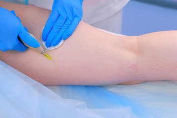 Doctor is making injection of carbon dioxide on patient's leg on carboxytherapy, body closeup. Cosmetologist woman using special apparatus. Treatment and remove of skin tags and stretches.