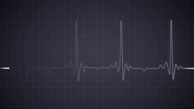 EKG Heartbeat on Monitor Recording of Pulse. Cardiac Arrest. Realistic Heart Rhythm Healthcare 
