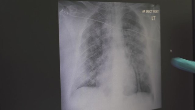 Doctor checking x-ray of lungs. Remote check-up. pulmonologist examines x-ray of covid-19 infected patient with viral pneumonia on display. Medical care in distance. Covid-19 or SARS-CoV-2 pandemic