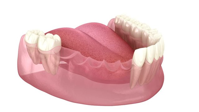 Dental bridge based on 3 implants. Medically accurate 3D animation of human teeth and dentures concept