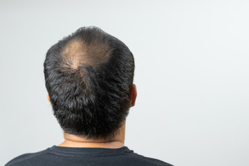 Close up man head of hair loss