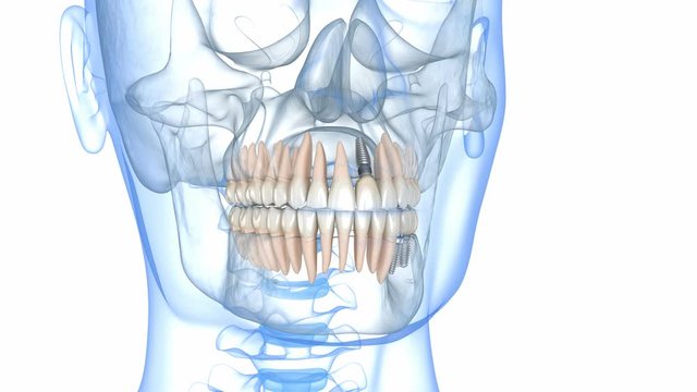 Recovery with Dental implants. Medically accurate 3D animation of human teeth and dentures concept