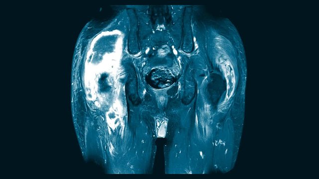 Magnetic Resonance Imaging (MRI) of both hip sagittal plane. Finding A large mixed heterogeneous fluid collection, located at intramuscular area of right gluteus maximus and gluteus medius muscles.