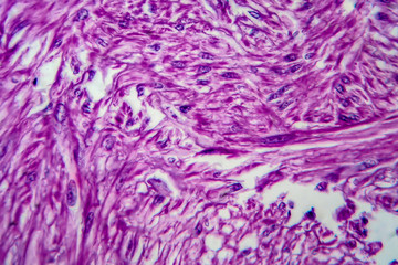Uterine tumour, light micrograph