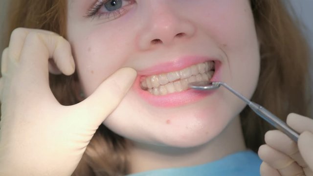 Orthodontist doctor looking with dental mirror on silicone invisible transparent braces on girl's teeth in stomatology clinic, mouth closeup view. Correcting teeth. Treatment and cure in dentistry.