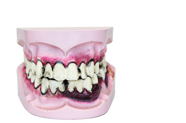 wooden dentures with caries and cavities on white background with copy space.  Dental Health care.