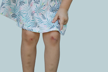 Child knee with scratches and bruises