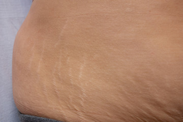 Postnatal changes as stretches on skin. After birth marks on belly of woman. Close-up view of...