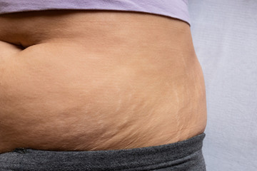 Postnatal changes as stretches on skin. After birth marks on belly of woman. Close-up view of...