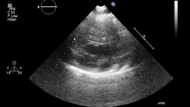 Transesophageal ultrasound video in gray-scale mode.