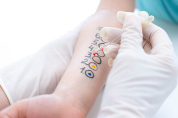 Allergen test on hand. child undergoing procedure of allergen skin test in clinic.