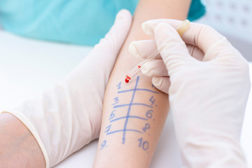 Allergen test on hand. child undergoing procedure of allergen skin test in clinic.