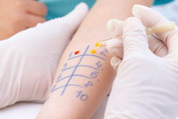 Allergen test on hand. child undergoing procedure of allergen skin test in clinic.