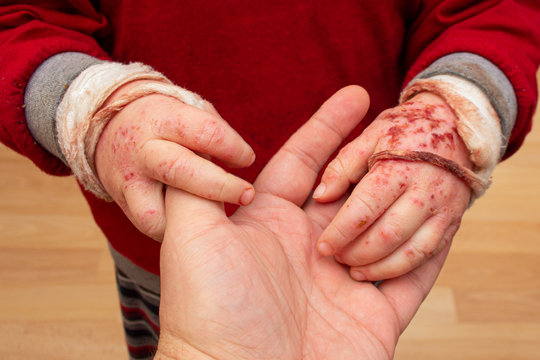 bloodied children's hands in bandages