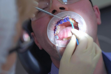 Dentist is applying blue gel on man's teeth to find dental tartar and caries. Hygiene care for oral...
