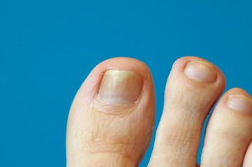 toe with nail psoriasis. A woman has an ingrown toenail. short cutted nails. Dermatitis. foot with...