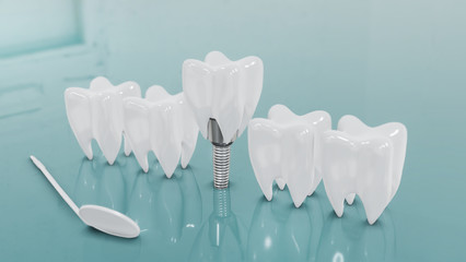 Dental Implants surgery concept, dentistry denture, Dental denture on green background. 3D render.