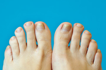 female feet foot legs. toes with nail psoriasis. A woman has ingrown toenails. short cutted nails....