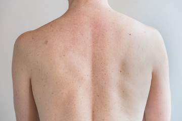 Back with a lot of moles and freckles. Concept of health. Examination by a doctor.
