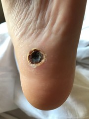 A foot wound and problem skin © Krasimira Nevenova