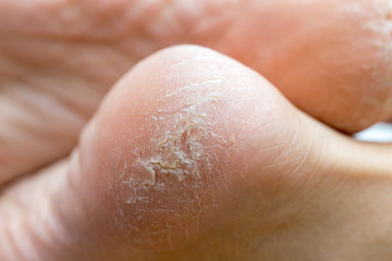 dry dehydrated skin on the heels of female legs