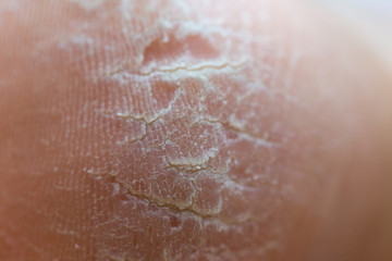 dry dehydrated skin on the heels of female legs