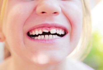 Fototapeta premium Kid with crooked teeth. Girl show her diastema teeth.
