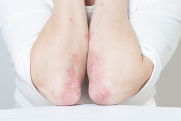 Acute psoriasis on the elbows is an autoimmune incurable dermatological skin disease. Large red, inflamed, flaky rash on the knees. Joints affected by psoriatic arthritis