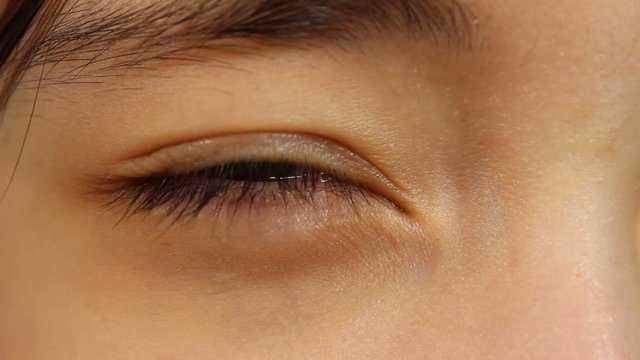 The girl blinks her eye, which is beginning to water a lot. Light irritation or Allergy.