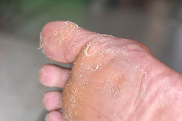 Athlete's foot skin disease. Fungal infection.
