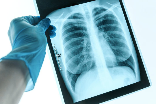Doctor hands holding patient chest x-ray film before treatment.Covid-19 scan body xray test detection for covid virus epidemic spread concept.
